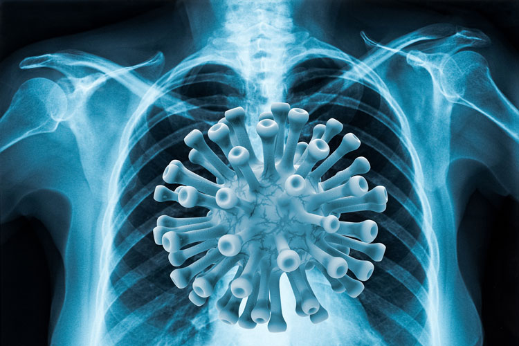 Artistic rendering of chest radiograph with COVID-19